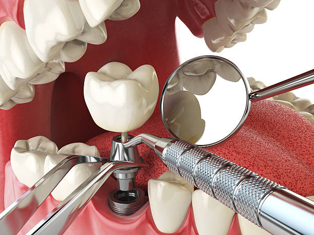 Best Emergency Treatment for Dental Infections or Abscesses in Capac, MI